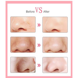 6 Başlıklı Vakumlu Siyah Nokta Temizleyici 6 Başlıklı Vakumlu Siyah Nokta Temizleyici